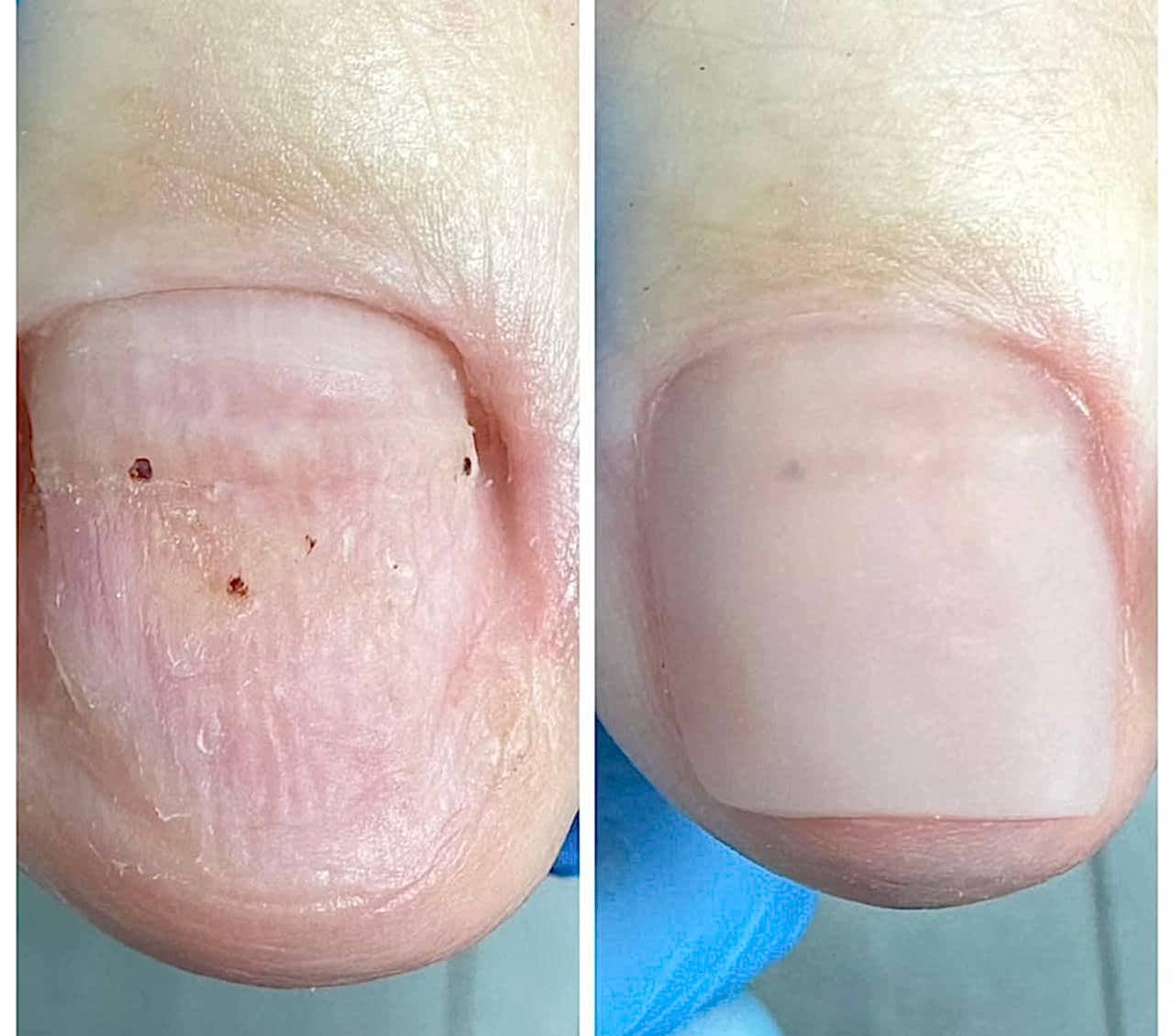 Протезирование ногтей